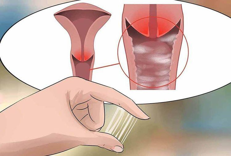 Signs of Infection After Abortion